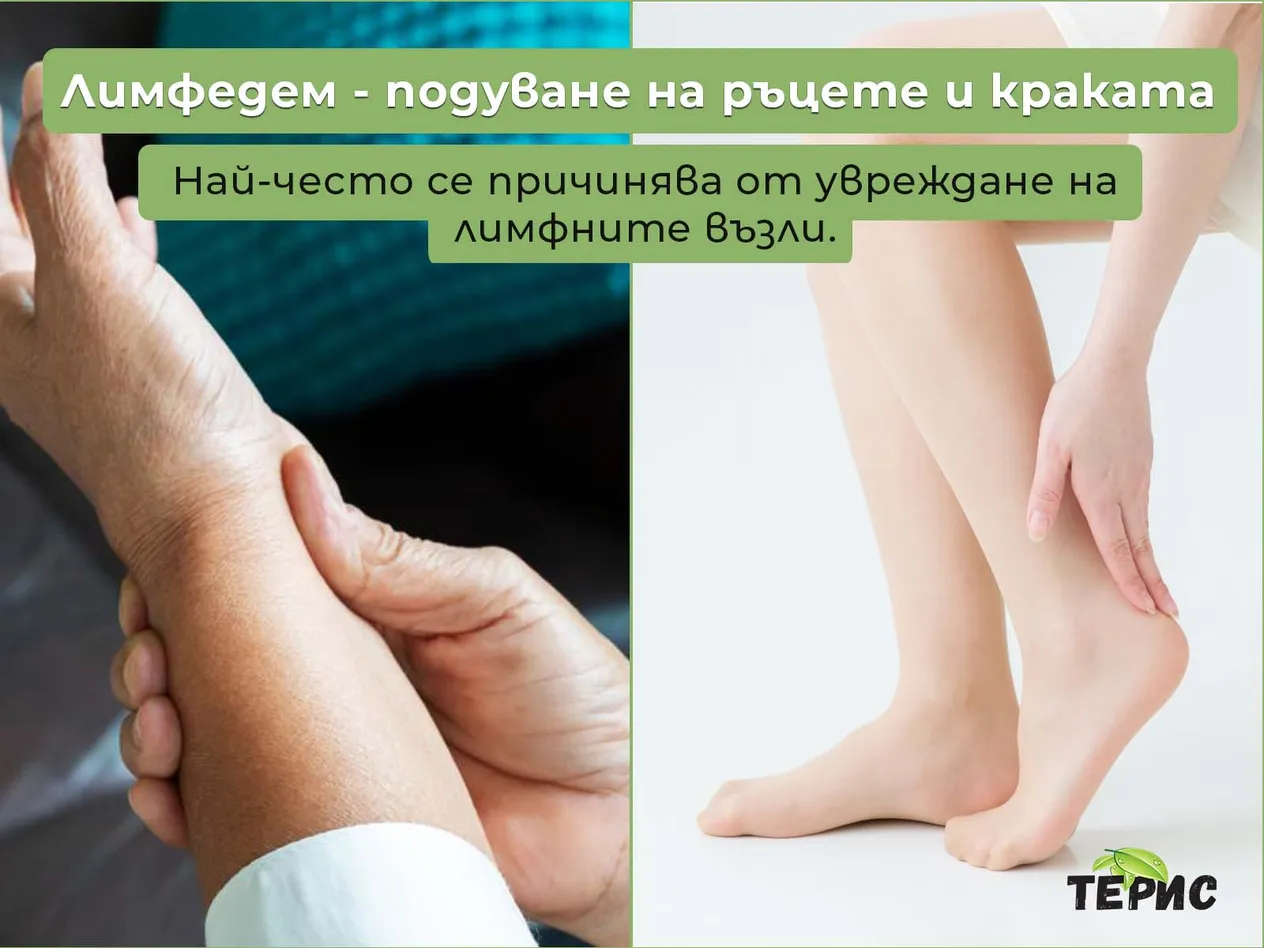 Лимфедем - подуване на ръцете и краката