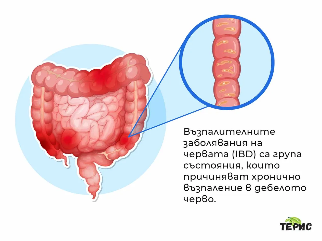 Възпалителни заболявания на червата - IBD