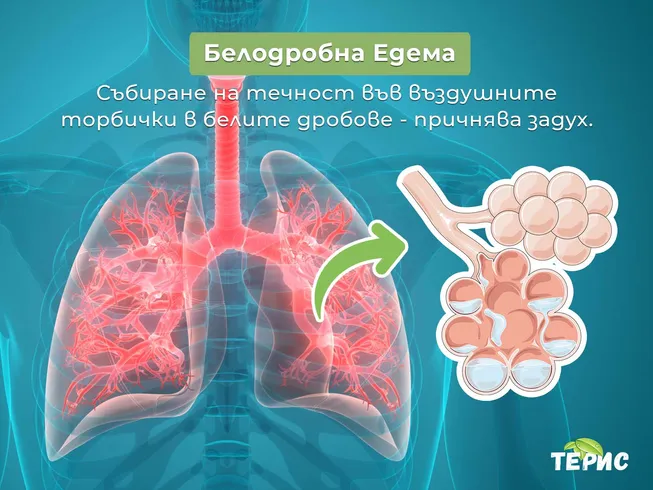 Белодробна Едема - събиране на течност в белите дробове