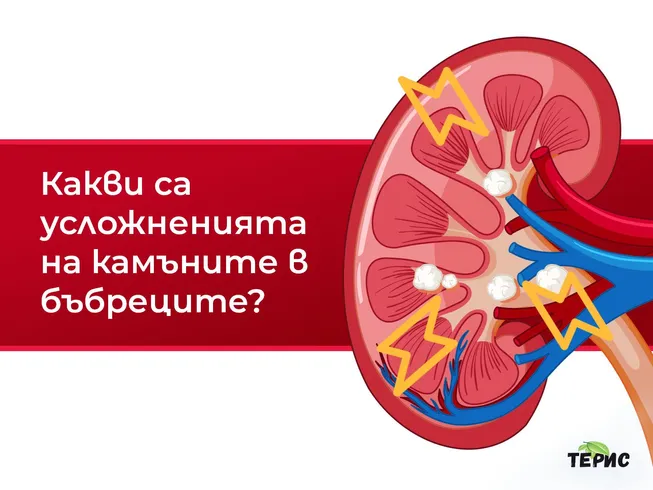 Какви са усложненията на камъните в бъбреците?