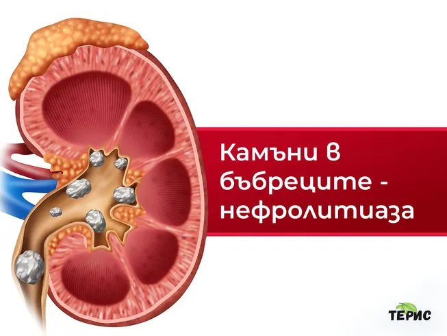 Камъни в бъбреците - нефролитиаза