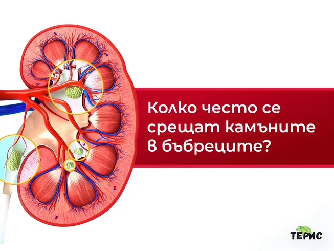 Колко често се срещат камъните в бъбреците?